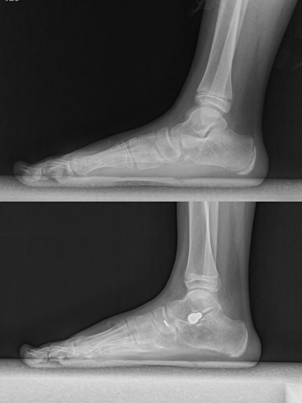 Subtalar Joint Stabilization Screw